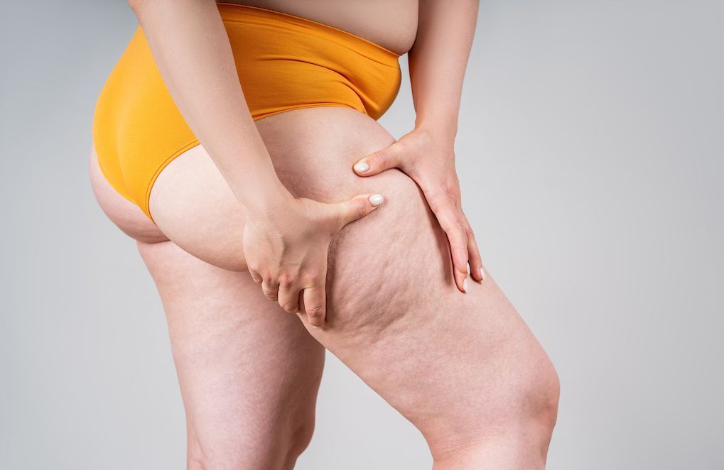 Maladie du LIPOEDÈME